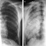 Confirmados los primeros casos de silicosis por el uso de encimeras de piedra artificial: piden retirarlas de esta forma