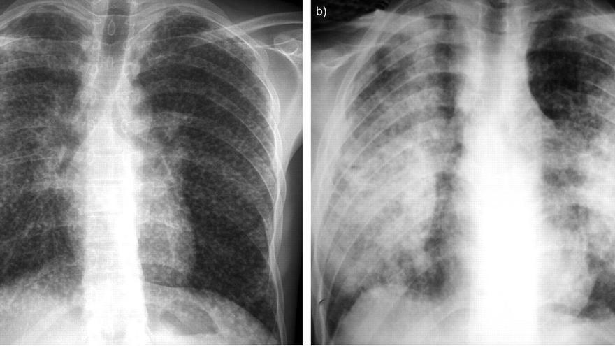 Confirmados los primeros casos de silicosis por el uso de encimeras de piedra artificial: piden retirarlas de esta forma