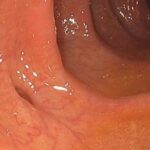 Divertículos en el colon: Qué son, cómo prevenirlos, sus síntomas y opciones de tratamiento