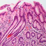 Helicobacter pylori: así son los síntomas de la infección que afecta a la mitad de la población