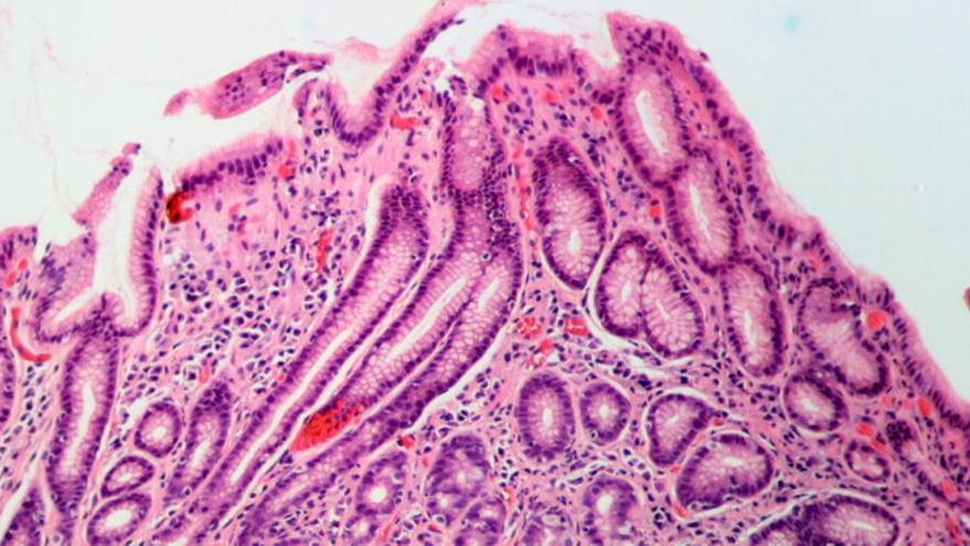 Helicobacter pylori: así son los síntomas de la infección que afecta a la mitad de la población