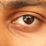 ¿Por qué tengo ojeras si duermo bien? Descubre las 4 enfermedades que pueden ser la causa
