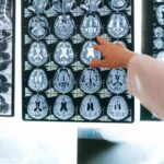 Los consejos del neurólogo para mantener sano nuestro cerebro y evitar el ictus, alzhéimer…