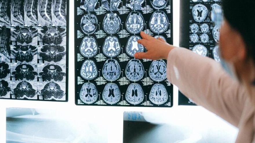 Los consejos del neurólogo para mantener sano nuestro cerebro y evitar el ictus, alzhéimer…