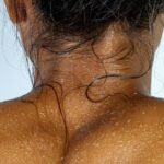 Hidradenitis supurativa: qué es y por qué se llaman bartolillos o golondrinos los granos gigantes