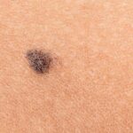 Melanoma: así puedes detectar a tiempo el cáncer más agresivo que no para de aumentar en España