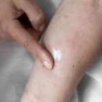 Las cremas y geles que realmente funcionan para aliviar la dermatitis atópica