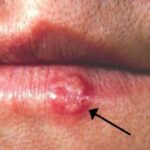 La infección por herpes labial se asocia a un mayor riesgo de alzhéimer, según un estudio