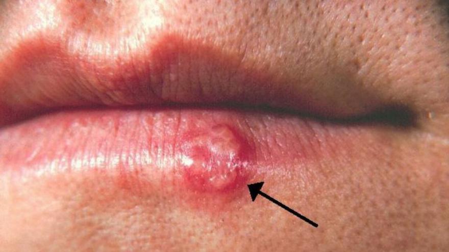 La infección por herpes labial se asocia a un mayor riesgo de alzhéimer, según un estudio