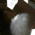 La mortalidad por cáncer de mama en España ha caído un 42% en las últimas tres décadas
