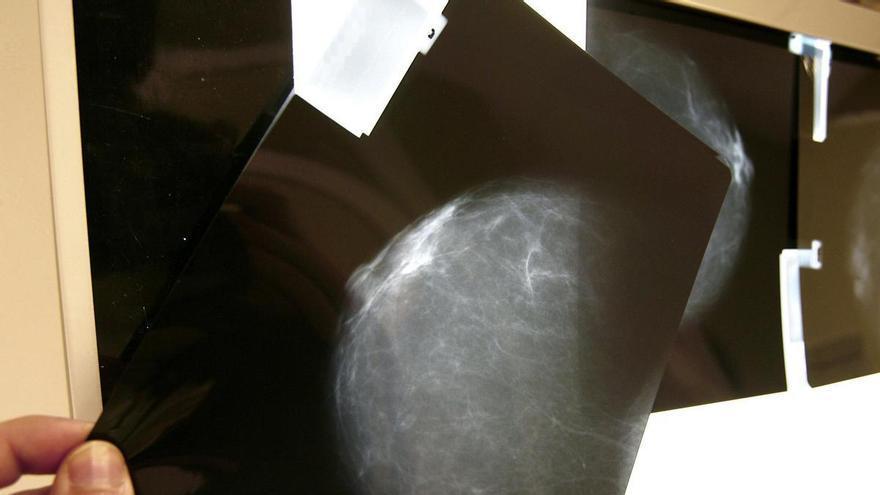 La mortalidad por cáncer de mama en España ha caído un 42% en las últimas tres décadas